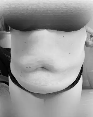 Photo avant, Transformation ventre et hanches