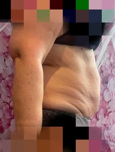 Photo après, Traitement cryolipolys
