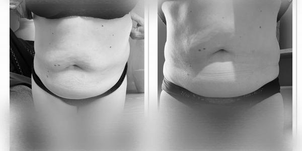 Cryolipolyse 