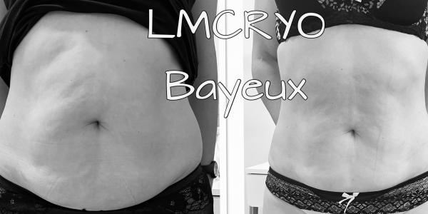 Résultat chez LM CRYO à Bayeux 