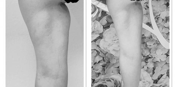 Cryolipolyse+cavitation+radiofrequence
