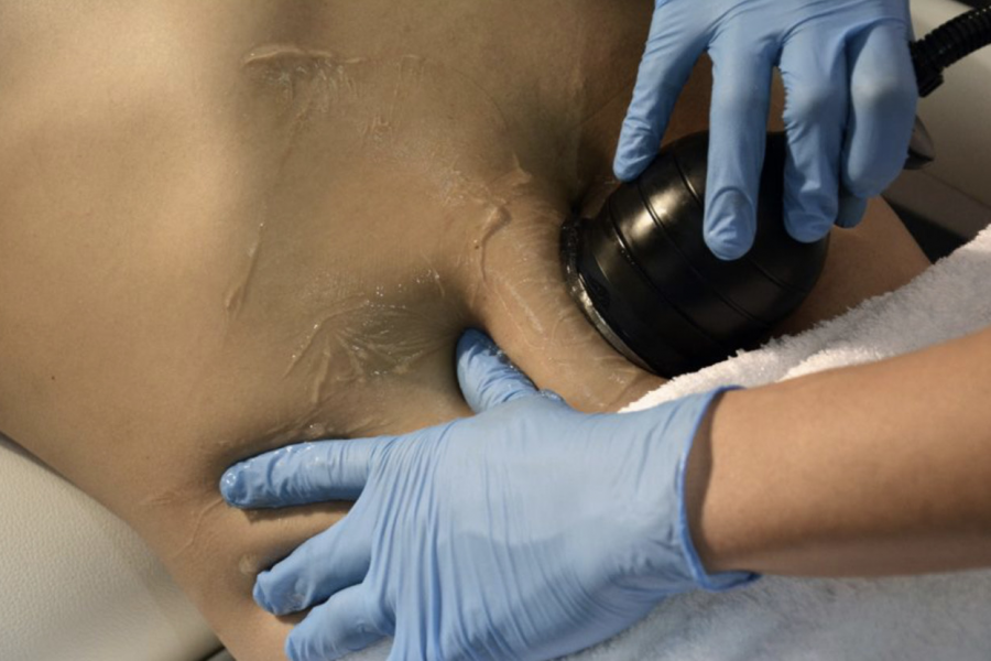 Image La cavitation