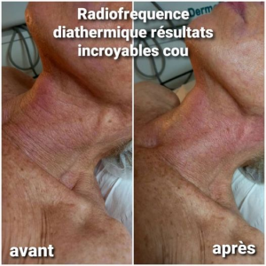 La radiofréquence a des résultats incroyables sur le cou